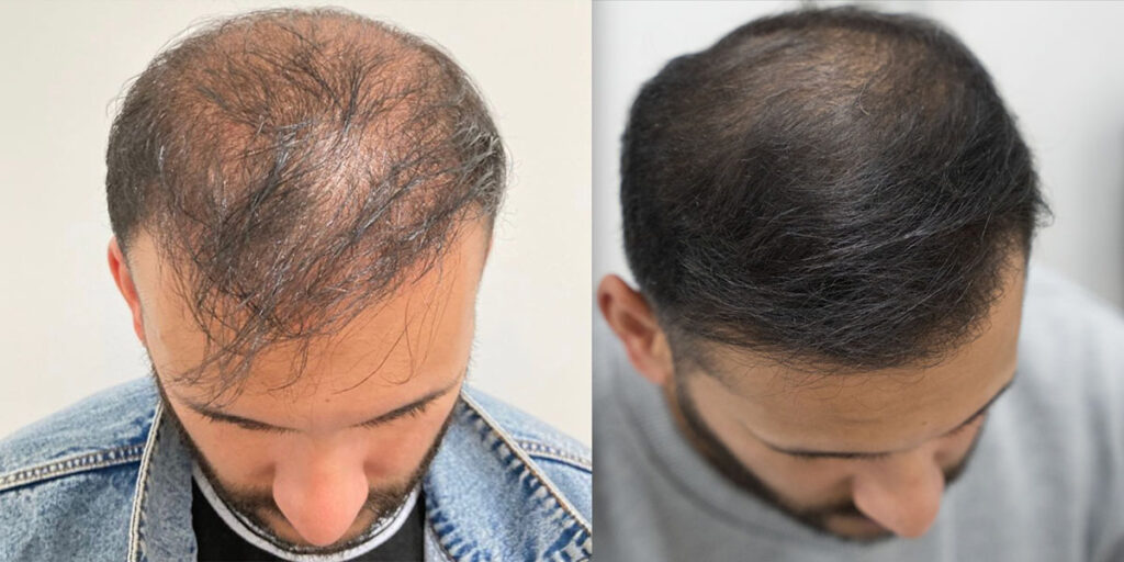 hairloss before after